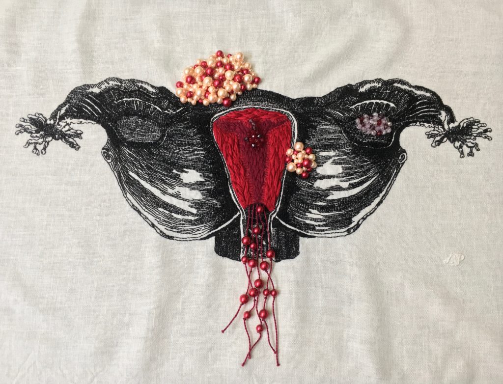 An embroidery of a uterus stitched in black thread on white linen with texture like a woodcut. The mesometrium spreads like wings, the ovaries are ovals on the mesometrium, and the fimbriae on the ends of the fallopian tubes look like sea anemones. Inside the uterus, the edges of the endometrium are stitched in bright red thread with long and short stitch in a textured leaf pattern. The centre endometrium is filled with the same texture but in burgundy with thinner thread. The edges between the burgundy and the bright red are filled with single strand satin stitch with curlicue edges. There is an apple-sized half circle fibroid on the left upper area of the uterus and a strawberry sized one on the right lower side. Both fibroids are made of red, pink, and cream beads of various sizes. Another strawberry sized section of clear, purple, and red beads is a cyst over the right ovary, and a small section of dark red and purple beads are a polyp inside the endometrium. There are long burgundy strings hanging from the bottom of the endometrium with medium and large red beads on them that extended past the vaginal opening. The initials L. P. are stitched in white on the right side of the image. 